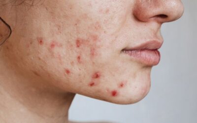 Tratamiento de acné en dermatología
