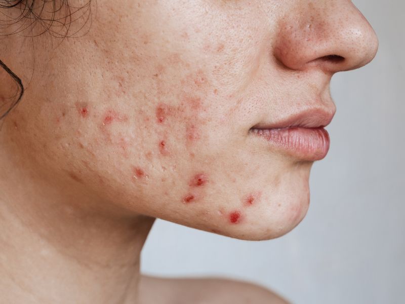 tratamiento acne dermatologia