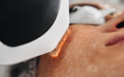 ¿Para qué sirve el láser IPL facial?