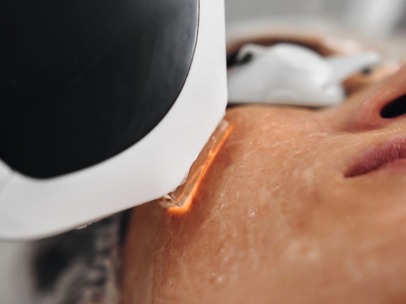 laser ipc facial