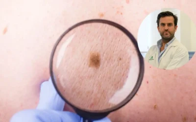 El melanoma, un cáncer con dos caras que sufren más de 200 malagueños al año: “La cirugía es la única cura”