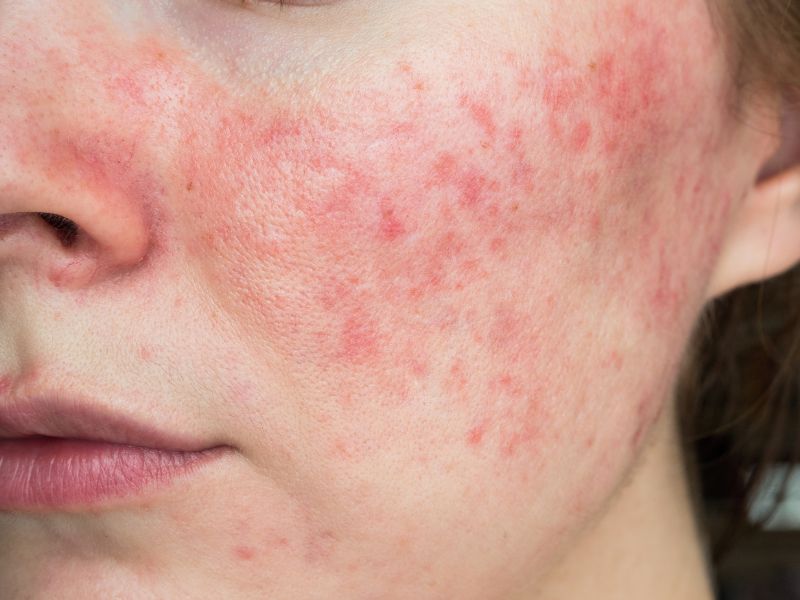 tratamiento rosacea