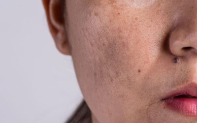Manchas blancas en la piel: causas, tipos y tratamientos