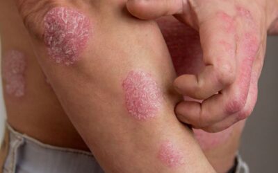Psoriasis: qué es, causas, síntomas, tratamientos y mucho más