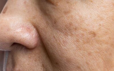 Realizamos un tratamiento de manchas solares y melasma
