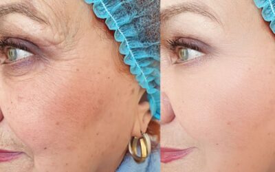 Ácido hialurónico para tratar arrugas: el mejor aliado