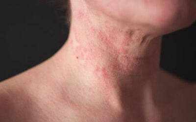 Dermatitis atópica: todo lo que tienes que saber