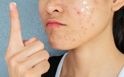 ¿Se pueden eliminar las cicatrices del acné?