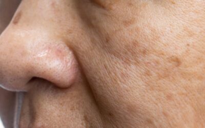 Melasma facial: qué es, causas, tratamientos y más